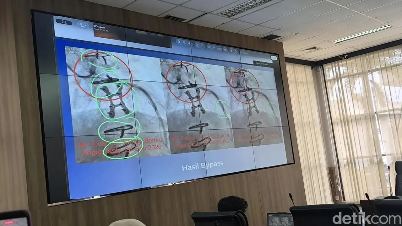 RSUD AWS Samarinda Buka Suara soal Kawat Tertinggal di Jantung Pasien